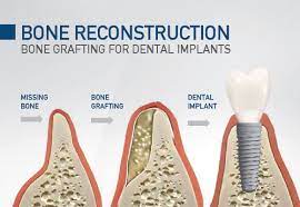 Bone Grafting Vancouver & Burnaby BC, Bone Graft Options for Implants